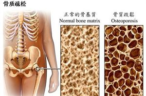 骨質(zhì)疏松