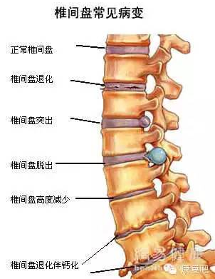 椎間盤常見病變