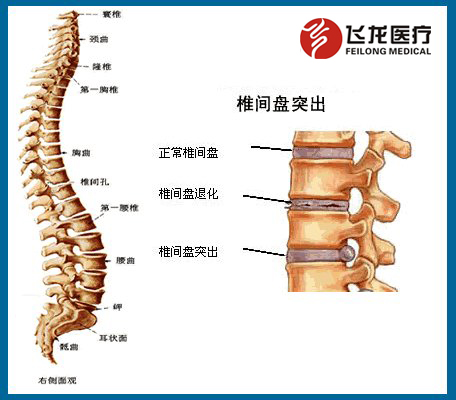 椎間盤突出癥狀