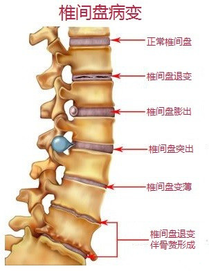 椎間盤病變